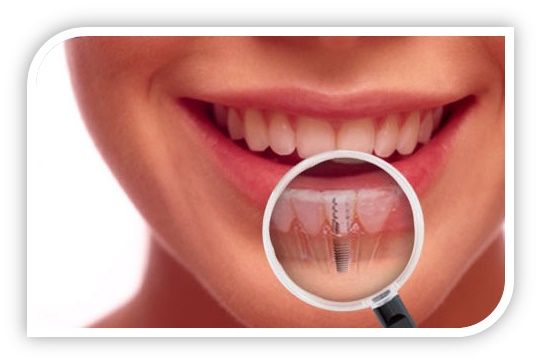Unique Reasons That Warrant Getting Dental Implants